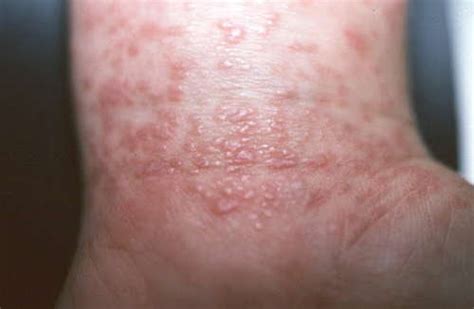 Hep C Rash Pictures Medical Pictures And Images 2023 Updated