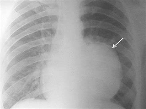 Chest Radiograph Showing A Large Lobulated Soft Tissue Mass Lesion