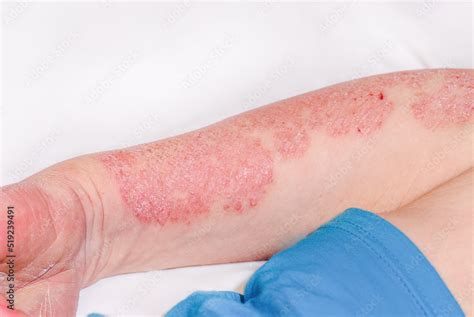 Acute Psoriasis On The Arm Of A Man Severe Redness On The Skin An