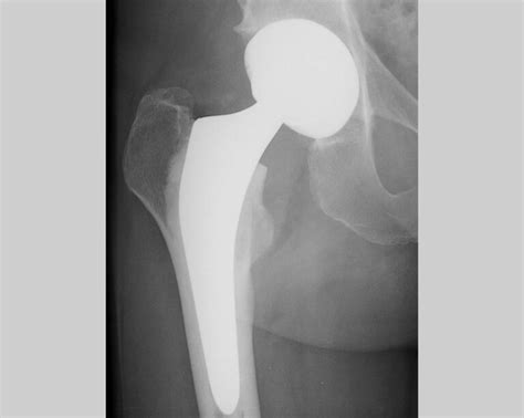 Minimally Invasive Anterior Approach Total Hip Replacement Doctor