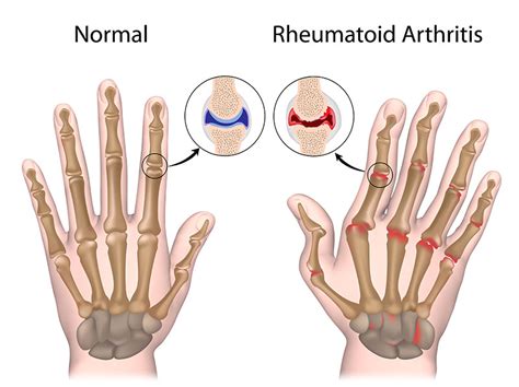 Rheumatoid Arthritis Arizona Arthritis Rheumatology Associates P C