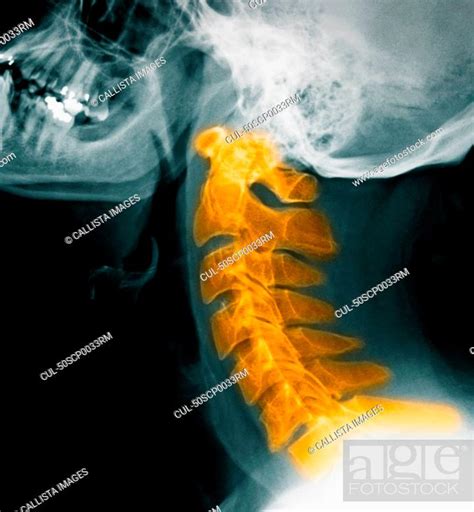 Cervical Spine X Rays Normal Stock Photo Picture And Royalty Free