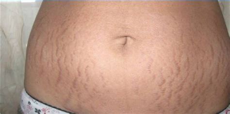 How To Remove Stretch Marks On The Stomach Effective Methods Of