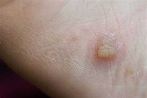 Photo Libre De Droit De Eczéma Dyshidrotique Sur Le Pied Dermatite