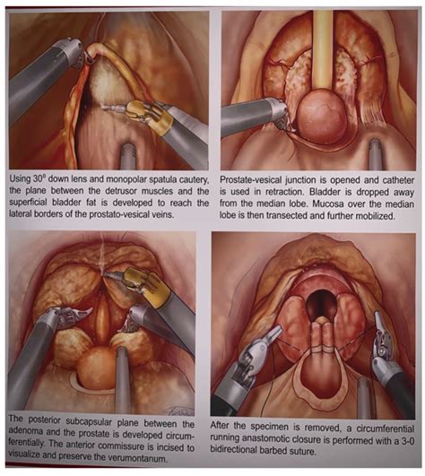 Suprapubic Prostatectomy Procedure