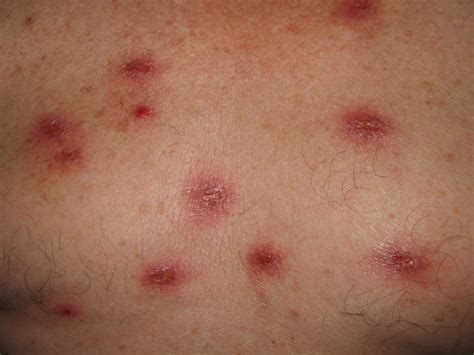 Harbor Hospital Residents Pow Insect Bites Or Psychogenic Lesions