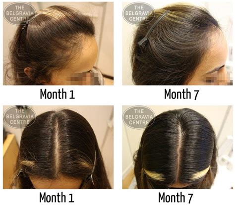 Top 100 Image Womens Hair Loss Treatment Vn
