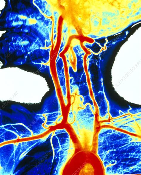 Coloured Angiogram Of Carotid Arteries Stock Image P2060074