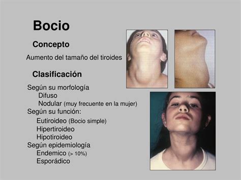 Ppt Fisiopatologia Tiroidea Bocio HiperfunciÓn Tiroidea Hipofuncion