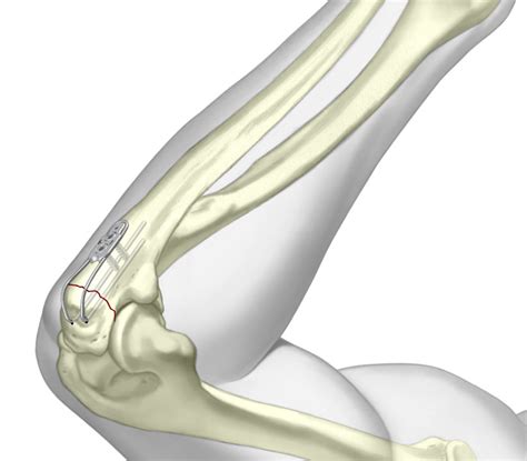 Olecranon Sled Elbow Fracture Fixation Trimed Inc
