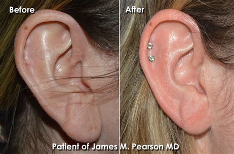 Earlobe Reduction Photos Before And After Dr James Pearson Facial