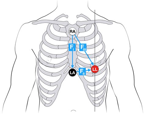 Ecg Lead Positioning Litfl Medical Blog Ecg Library Basics