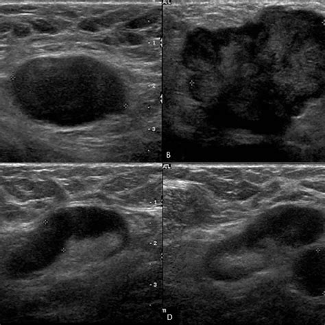 A Normal Axillary Lymph Node In A 62 Year Old Female Patient On