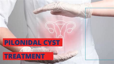 Pilonidal Cyst Treatment Inscmagazine