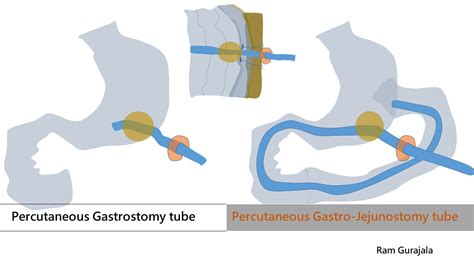 Percutaneous Gastrostomygastro Jejunostomy Tube Placement Ir 4 U