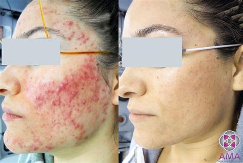 Tableskirtingdesigns Acne Scars And Pimples Treatment