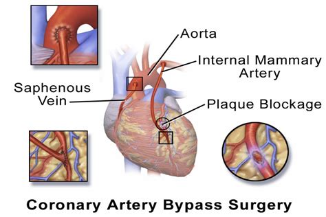 Coronary Artery Bypass Grafting Cabg Treatment Cost Guide