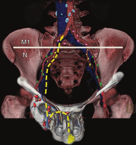 Schematic Shows The Most Common Pathway Of Metastasis From Penile