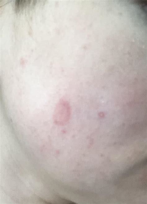 Circle Red Rashflat Mark 2 Months On Accutane And Have Woken Up With