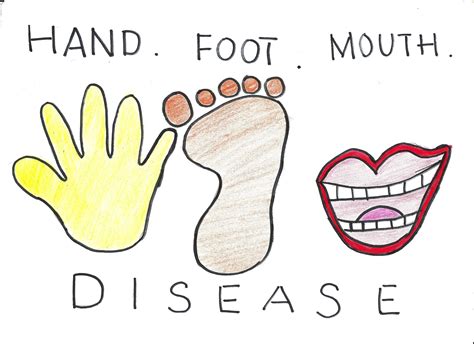 Don't hug or kiss someone who has hand, foot, and mouth disease. Penyakit Kaki-Tangan-Mulut ( Hand Foot Mouth Disease ...