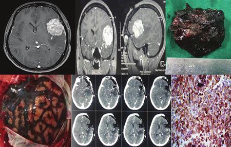 Images Of Case 1 Showing Preoperative Magnetic Resonance Imaging Brain