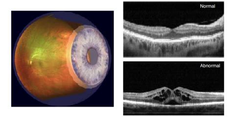 Optos Retinal Exam Eye Doctor In Nashua New Hampshire