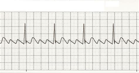 Ekg Atrial Flutter Rhythm Strip Images And Photos Finder