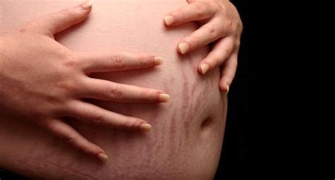 Heres How To Prevent Stretch Marks During Pregnancy
