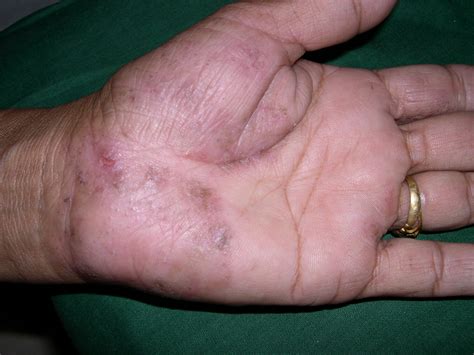 Tinea On Hand Pictures Photos