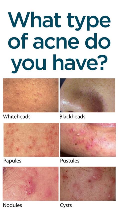 What Type Of Acne Do You Have Find Out How The Different Types Are