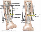 Deformity Correction: The Process | International Center for Limb ...