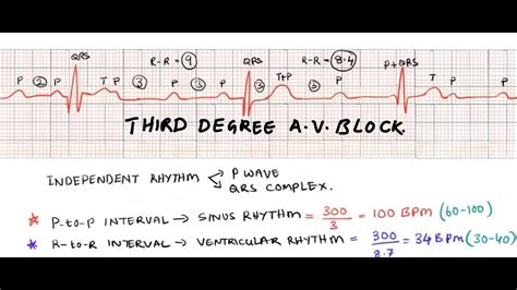 Atrioventricular (av) block is partial or complete interruption of impulse transmission from the atria to the ventricles. Third degree heart block/ complete A V block/ ECG ...