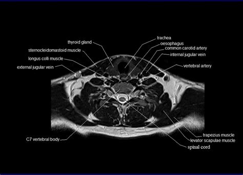 This article looks at the anatomy of the back, including bones, muscles, and nerves. MRI neck anatomy | free MRI axial neck cross sectional anatomy