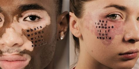 Models With Skin Conditions Answer Hurtful Questions In Powerful