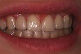 Before and After Dental Bridges Photos