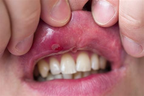 Is That A Blood Blister In Your Mouth Pics Symptoms And Cures