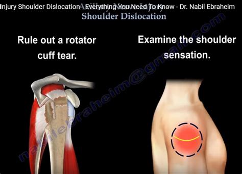 Axillary Nerve Injury In Shoulder Dislocation —