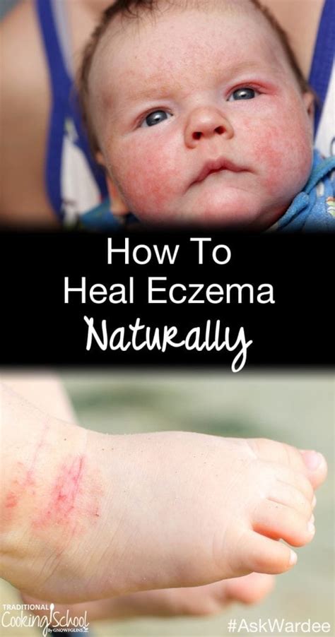 How To Heal Eczema Naturally Askwardee