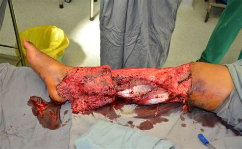 MAJOR CIRCUMFERNTIAL DEGLOVING INJURY - Gross instability fo the knee ...