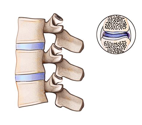 Understanding Facet Joint Syndrome Houston Neurosurgery And Spine