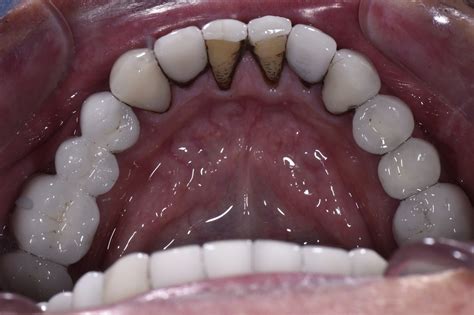 Severe Staining from Floradix | Iron Supplement Staining on Teeth