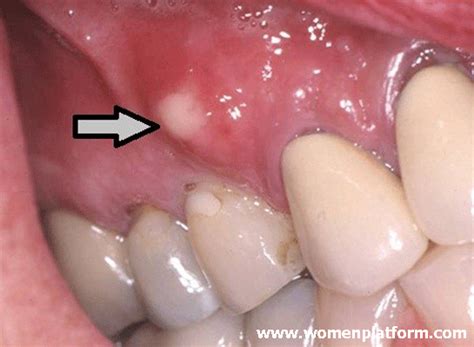 What Causes Tooth Decay What To Do To Treat Gum Swelling Women Platform