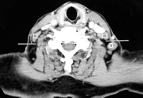 Cervical Lymph Node Levels