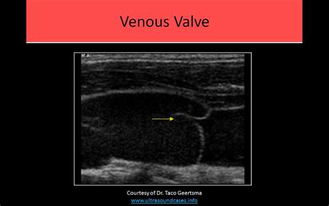 Extremity Venous Vascular Ultrasound Diagnostic Medical Sonography