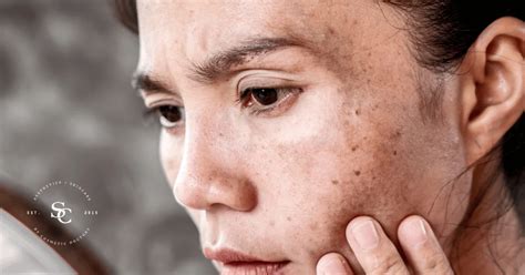 What Is Dull Skin Learn Symptoms Causes And Prevention