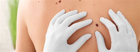 Skin Cancer Treatment Aspen Dermatology And Aesthetics