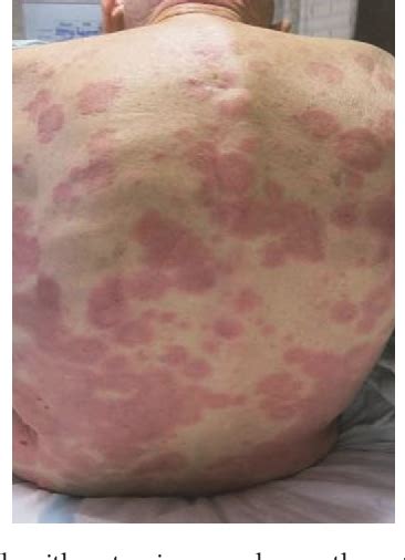 Figure 4 From A Rare Case Of Vancomycin Induced Linear Immunoglobulin A