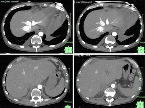 Abdominal Ct Scan At 8 Months Prior To The Donor Surgery There Was No