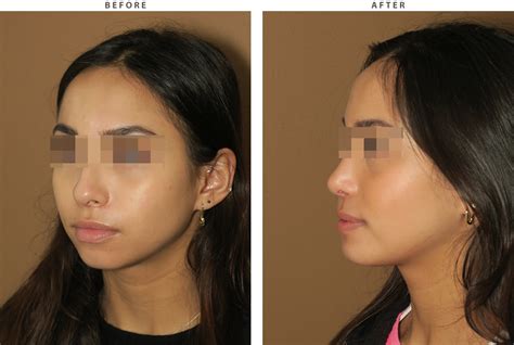 Rhinoplasty Before And After Pictures Dr Turowski Plastic