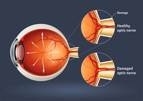 Glaucoma Awareness Month Discovery Eye Foundation